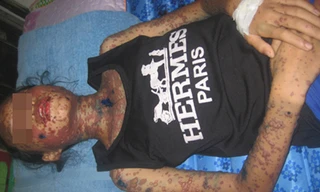 Bệnh nhân N.T.K.T nhập viện trong tình trạng bị bỏng rộp toàn thân, li bì, sốt cao, tinh thần rối loạn và được chẩn đoán bị hội chứng Liell, nghĩ nhiều đến dị ứng thuốc.