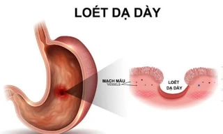 Ăn kiêng đúng cách cho người bị loét dạ dày