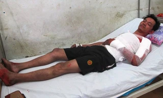 Anh Quang, một trong 5 người bị thương do vụ nổ, hiện điều trị tại bệnh viện đa khoa Nghệ An. Ảnh: Phạm Hòa.