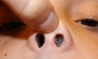 Những vị trí khó ngờ tiết lộ ung thư