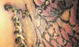 Thanh niên 29 tuổi biến chứng lở loét vì xoá xăm