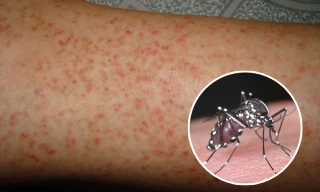 Sốt phát ban: hầu hết các trường hợp bắt đầu với triệu chứng sốt cao từng cơn (39-40 độ C) và xuất hiện ho, đau họng, chảy nước mũi hoặc nghẹt mũi, mệt mỏi, các hạch khu vực đầu, mặt, cổ thường sưng to, đau có thể nhìn hoặc sờ thấy.