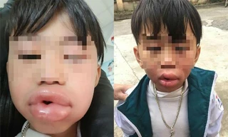 Hình ảnh cháu bé bị sưng môi sau khi ăn kẹo. Ảnh: GĐCC.