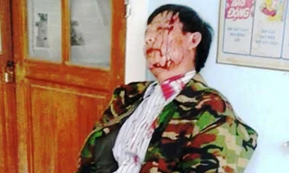 Ông Nguyên mặt đầy máu me thời điểm giằng co với Trưởng công an xã Phong Xuân. 