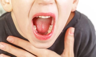 Viêm VA và các dấu hiệu trở nặng