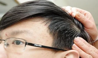 Nhìn vị trí tóc bạc sớm đoán nhiều bệnh nan y