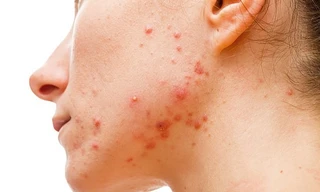 Khi bị mụn trứng cá, cơ thể đang cố gắng cảnh báo về rối loạn nội tiết hoặc rối loạn tiêu hóa.