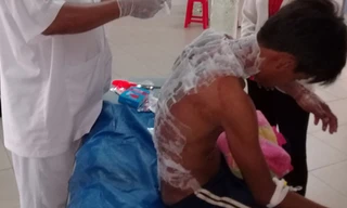 Dùng xăng đốt chuột, nam sinh bỏng nặng