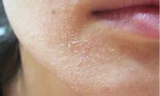 Lột trắng da làm đẹp không đúng cách coi chừng gây hại cho da.