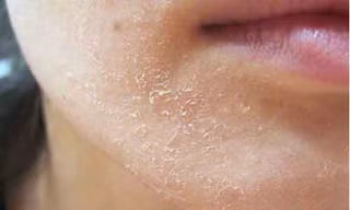 Lột trắng da làm đẹp không đúng cách coi chừng gây hại cho da.