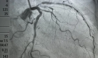 7 dấu hiệu thầm lặng của tắc động mạch