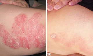 Hướng điều trị mới cho bệnh vẩy nến