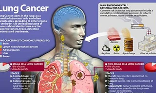 Thuốc lá – sát thủ số 1 gây ung thư phổi, lấy đi sinh mạng 1,8 triệu người mỗi năm