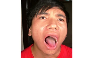 Mỗi khi lên cơn đau, nấm nem ở lưỡi em cứ lại xuất hiện cộng thêm nước bọt tiết ra nhiều khiến miệng bị sưng lên rất đau đớn.