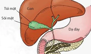 'Kẻ thù' của bệnh sỏi mật