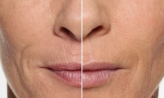 Những điểm lão hóa ở đôi môi làm bạn già đi