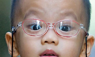 Khắc phục loạn thị cho con không cần đeo kính