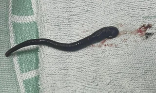 Gắp vắt sống dài gần 7cm trong mũi người phụ nữ