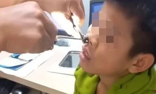 Gắp vắt dài 8cm 'ngoe nguẩy' trong mũi nam thiếu niên