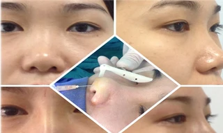 Sự thật về kỹ thuật nâng mũi S-line Hàn Quốc