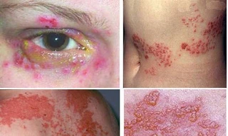 Sốt mò, căn bệnh bị lãng quên đã trở lại