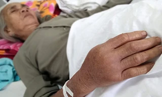 Cụ Điềm bị rắn lục đuôi đỏ cắn đang nằm điều trị tại Bệnh viện đa khoa Tây Hòa. Ảnh: Ngọc Thắng.