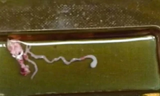 Sán dài 8 cm làm tổ trong não vì thức ăn đường phố