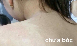 Nguy cơ ung thư khi lột da như rắn để làm trắng