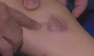 Bị bỏng bô xe máy, xử lý và điều trị thế nào?