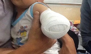 Cánh tay của bé sau tai nạn. Ảnh: Thiên Chương.