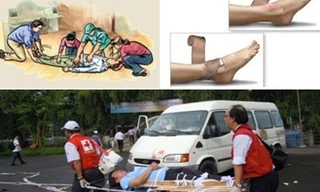 Dùng nẹp cố định xương để hạn chế vận động.