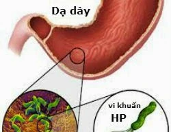 Tai biến là nguyên nhân gây tàn phế và mất trí nhớ ở nhiều người trưởng thành. (Ảnh minh hoạ: IE)