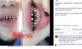  Chị T.N chia sẻ về tình trạng răng sau 2 năm bọc răng sứ.