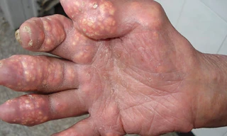 Bệnh nhân bị gút ở khớp ngón tay.