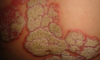 Thương tổn trên da ở bệnh nhân vẩy nến