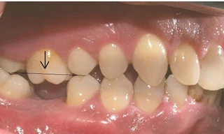 Mất răng cấm cần được trồng lại răng giả sớm