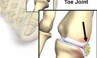 Nồng độ axit uric trong máu cao – Có phải mắc gút?