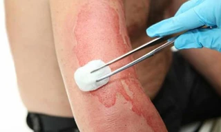  Nếu nạn nhân đang thở, hãy che phủ vùng bị bỏng bằng băng gạc vô trùng, hoặc bằng vải sạch. Ảnh: khoahoc.tv