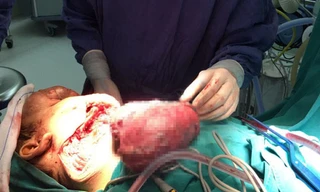 Ca mổ kỷ lục lấy lại gương mặt cho bệnh nhân có khối u ‘khủng’