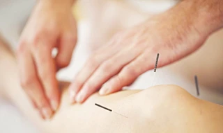 Hiểu đúng về châm cứu