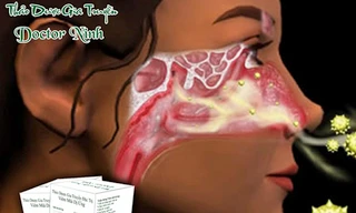 Cách chữa khỏi viêm mũi dị ứng trong 3 tuần 