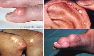 Hạt tophi xuất hiện ở nhiều vị trí trên cơ thể bệnh nhân gút