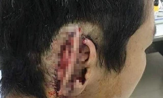 Ðiều tra vụ nghi vấn 'phê cỏ Mỹ' cắn đứt tai bạn