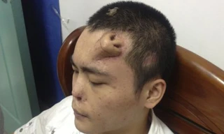 Mũi được tạo ra bằng sụn xương sườn trên trán