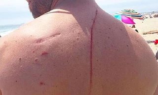 Anh Eugene Finney bị thương ở lưng. Ảnh: CBS Boston.