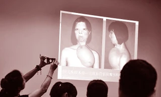 Khuôn mặt mới được cấy lên phía ngực trái của cô gái 17 tuổi Xu Jianmei