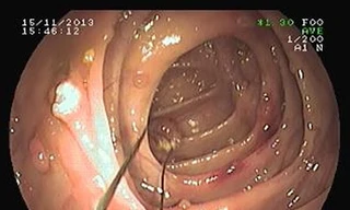 Nội soi cắt gần 40 u lành ở ruột già