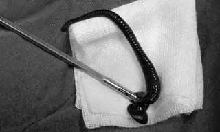 Con vắt nằm trong khí quản ông A Bói được bác sĩ gắp ra