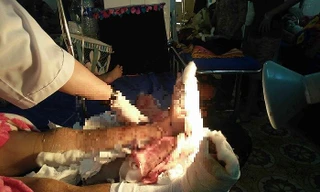 Hai cẳng chân của nạn nhân được các bác sĩ phẫu thuật ghép nối thành công