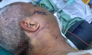 Ông Cường bị thanh sắt cắm vào vùng chẩm cổ xuyên ra đến tận góc hàm dưới.